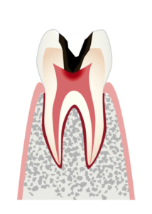 歯髄＝歯の神経まで達したむし歯