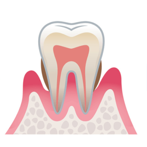 歯周炎（中等度）