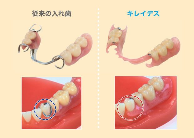 ノンクラスプデンチャー（キレイデス）メリット