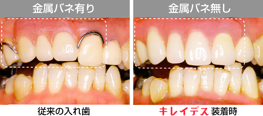 ノンクラスプデンチャー（キレイデス）症例