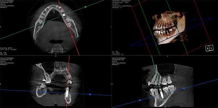 インプラント　CT撮影