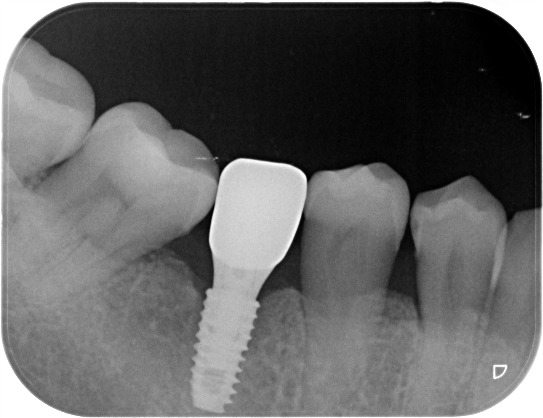 レントゲン写真