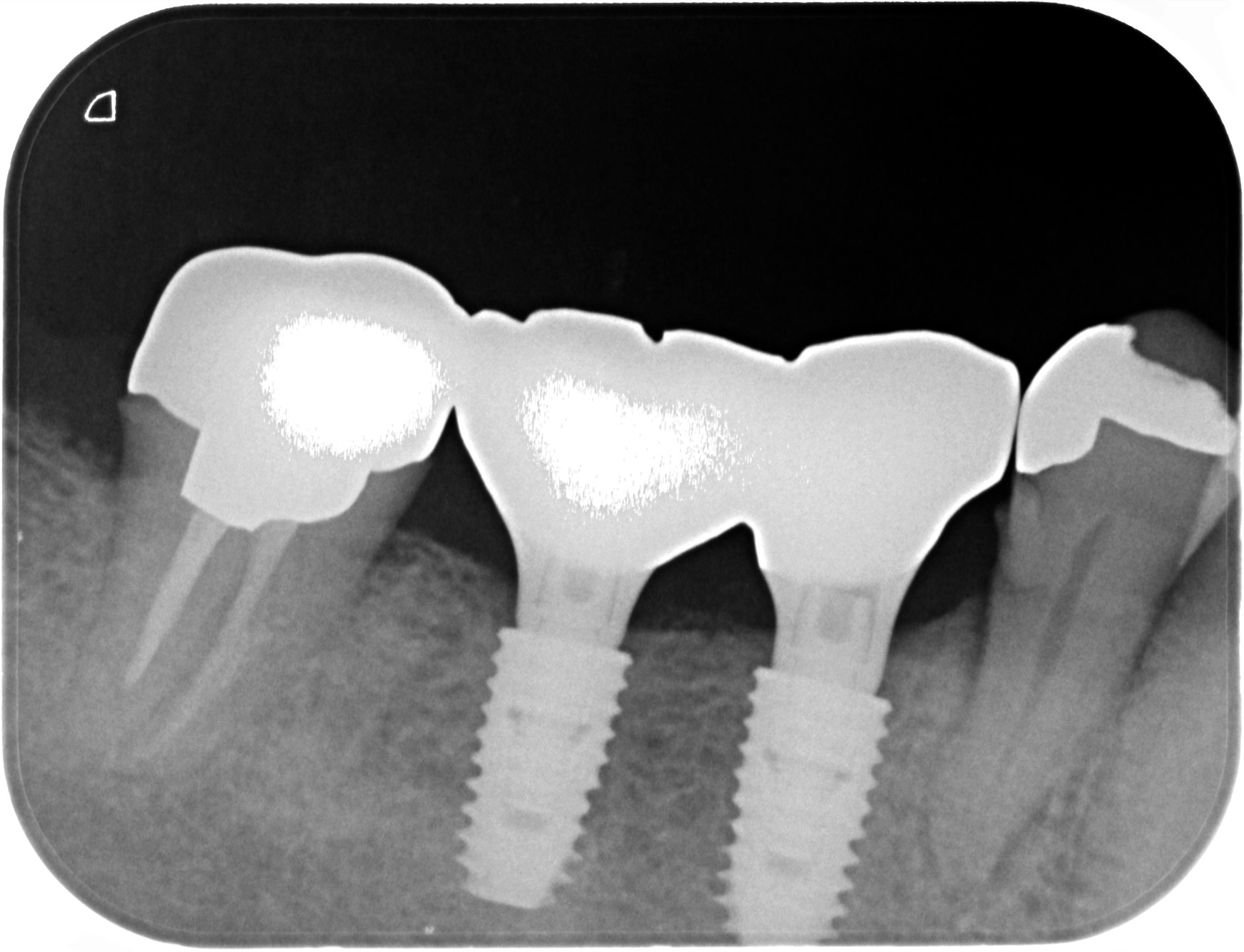 レントゲン写真