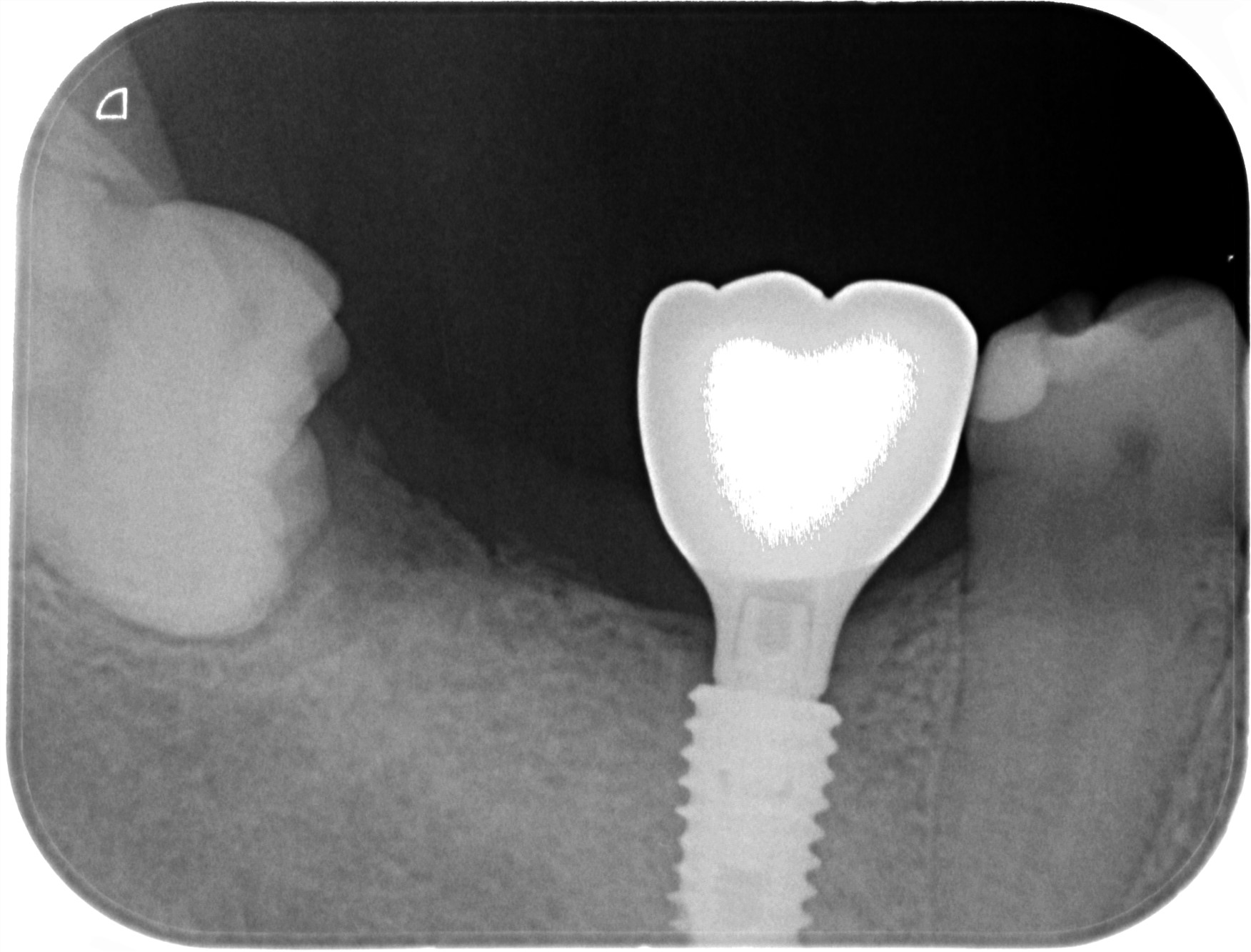 レントゲン写真