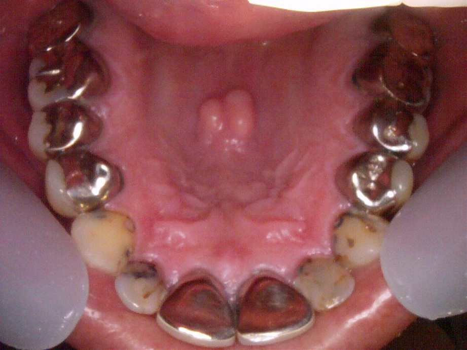 治療前（上顎）