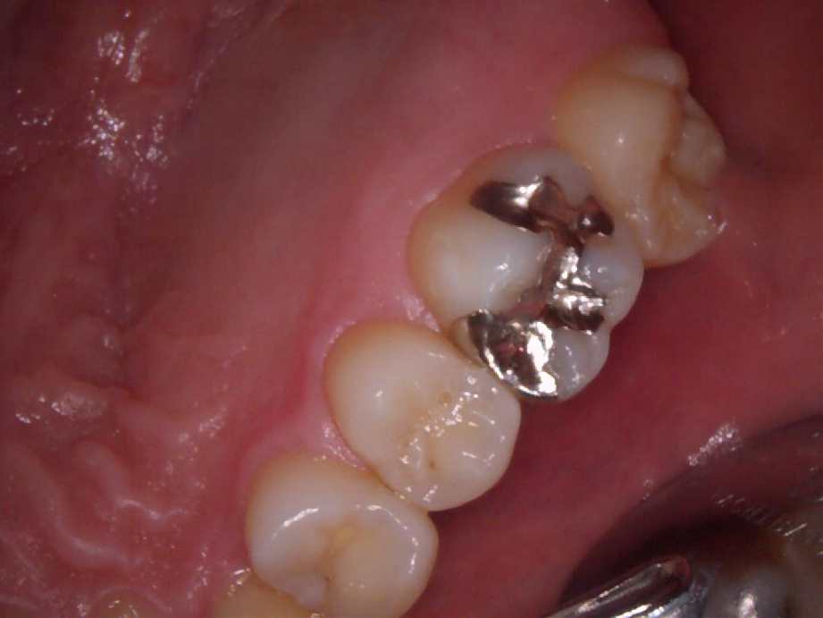 治療前（奥歯）