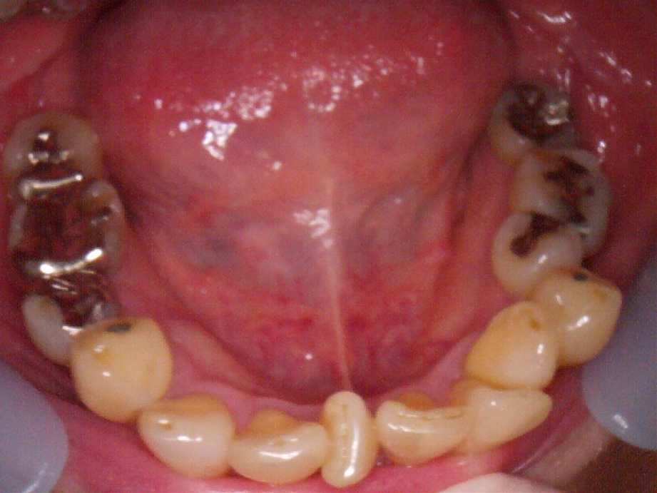 治療前（下顎）