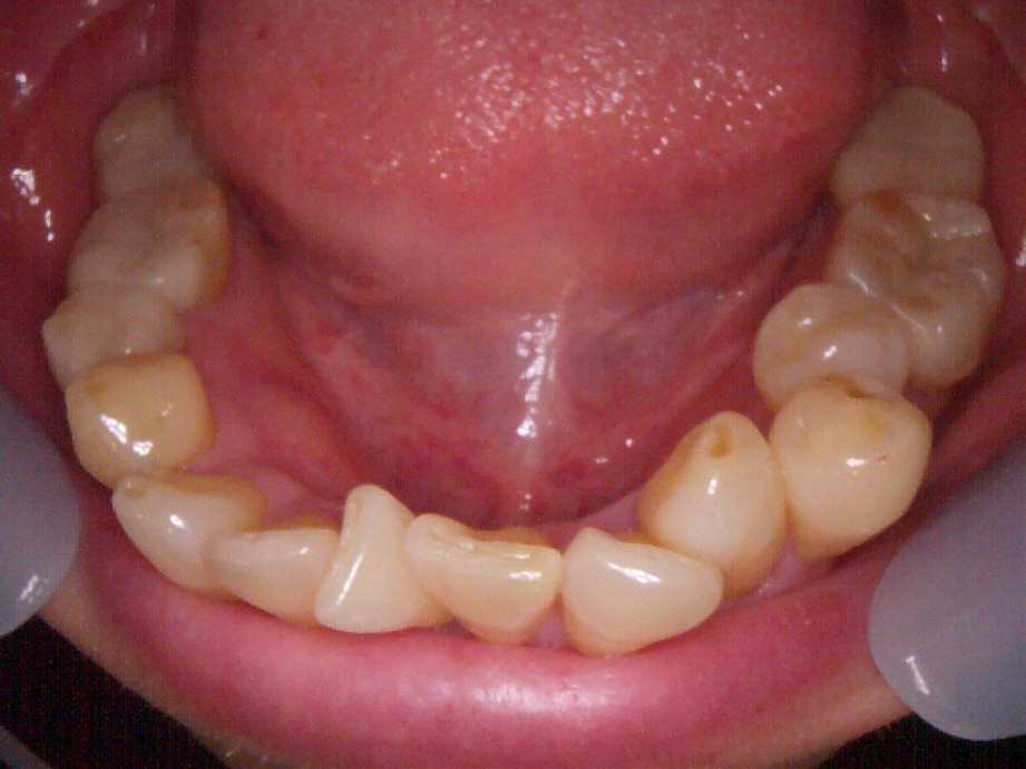 治療後（下顎）