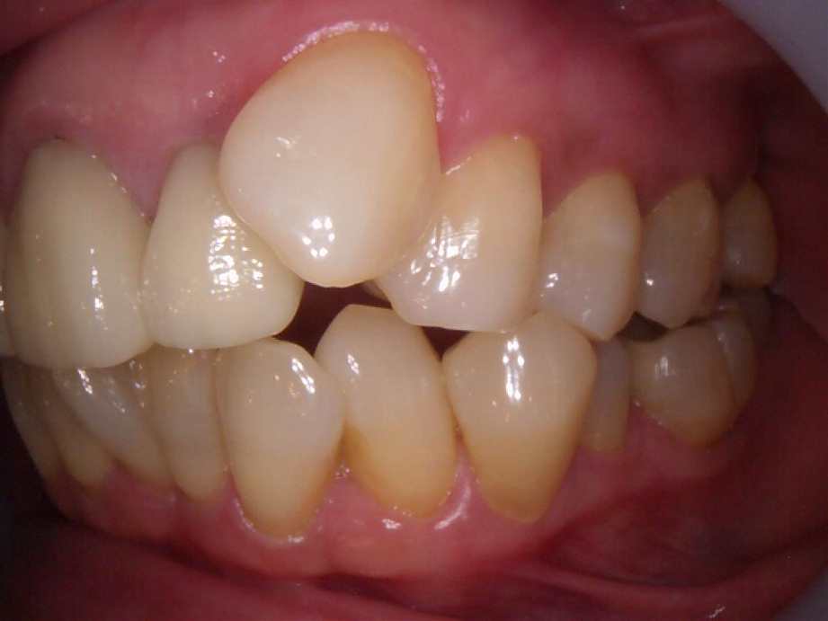 治療後（左側面）