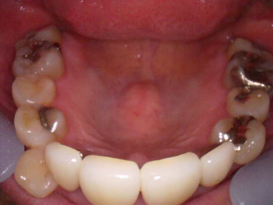 治療前（上顎）