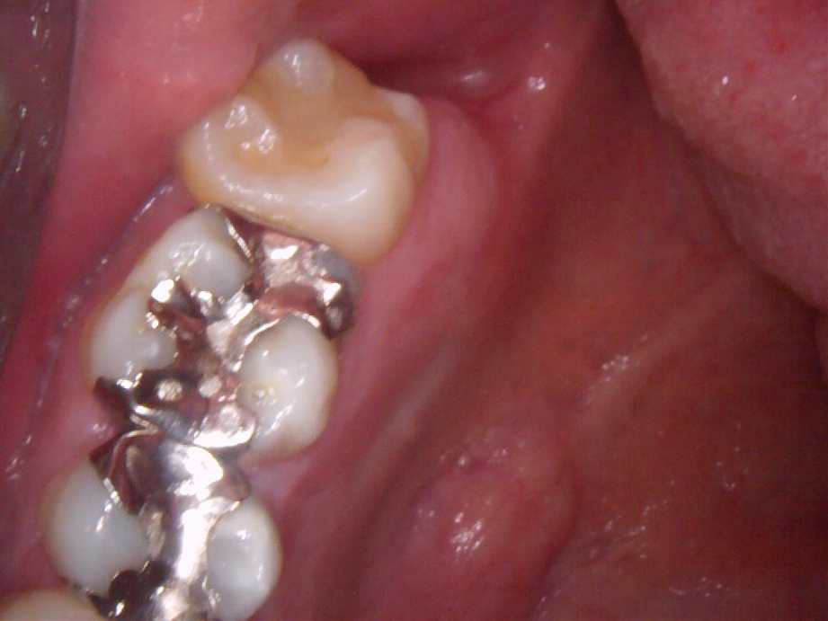 治療前（奥歯）