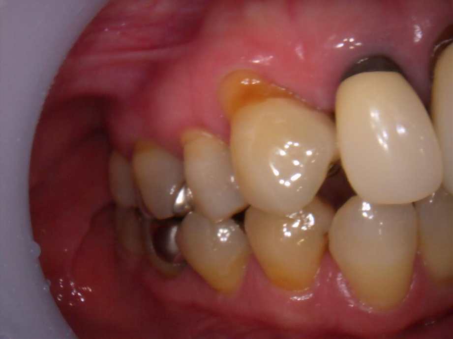 治療前（右側面）