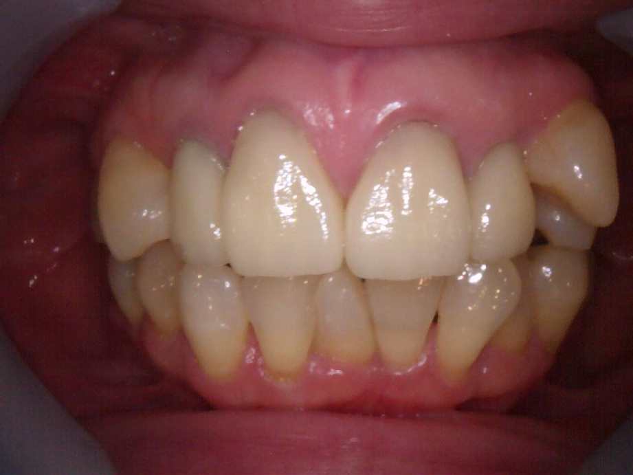 治療後（正面）