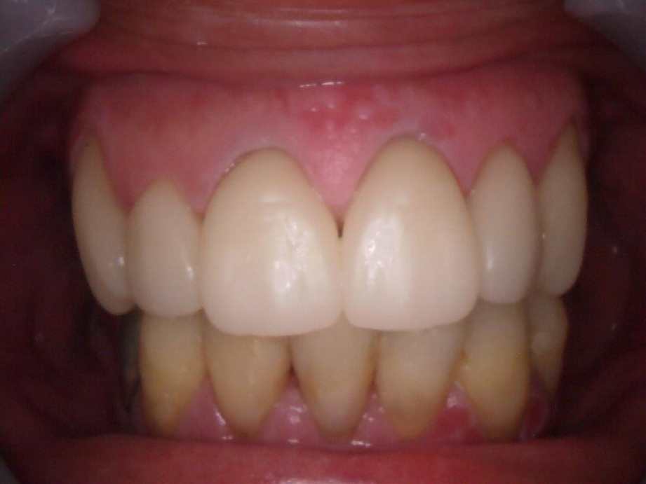 治療後（正面）