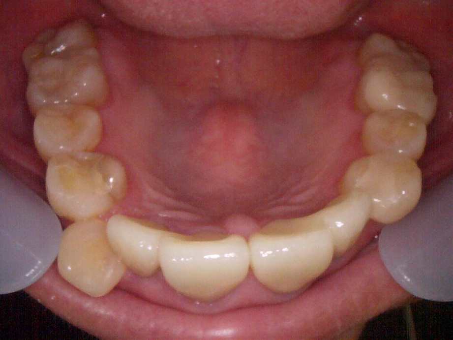 治療後（上顎）