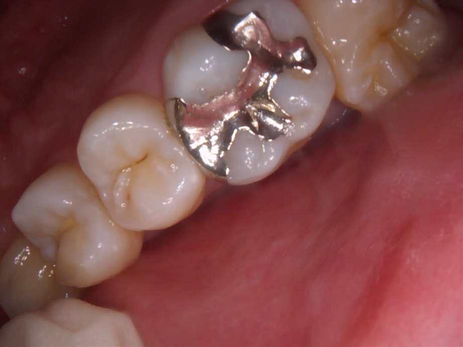 治療前（奥歯）