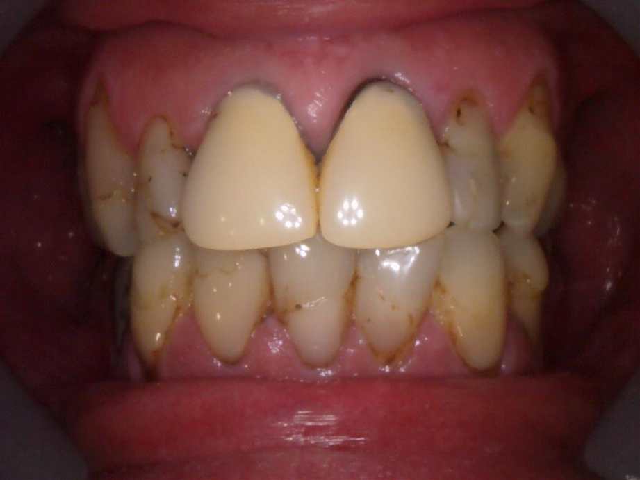 治療前（正面）