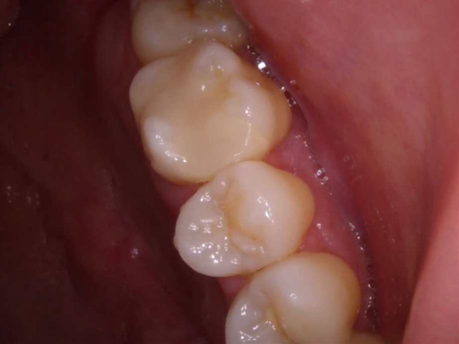 治療後（奥歯）