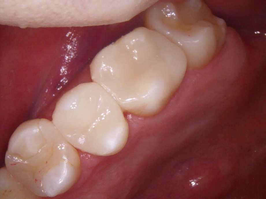 治療後（奥歯）