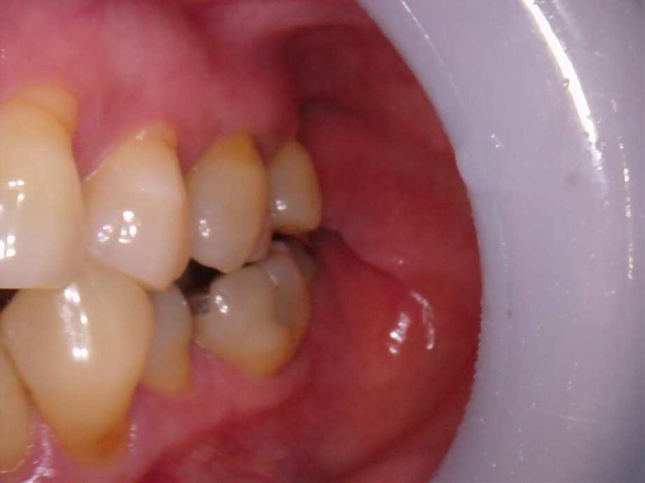 治療前（左側面）