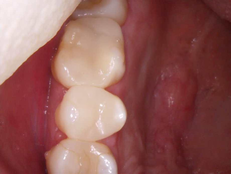 治療後（奥歯）