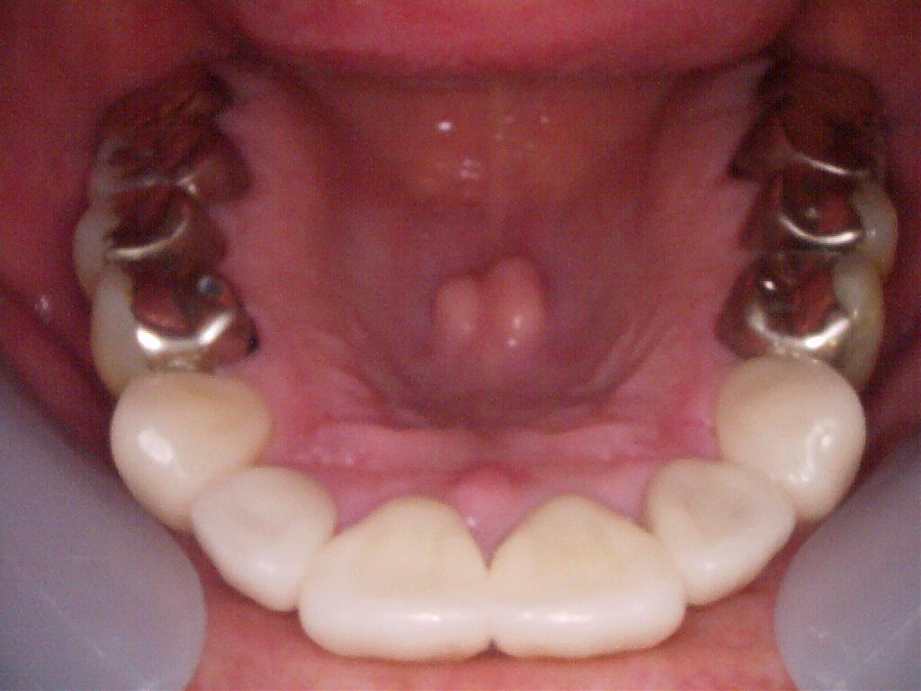 治療後（上顎）