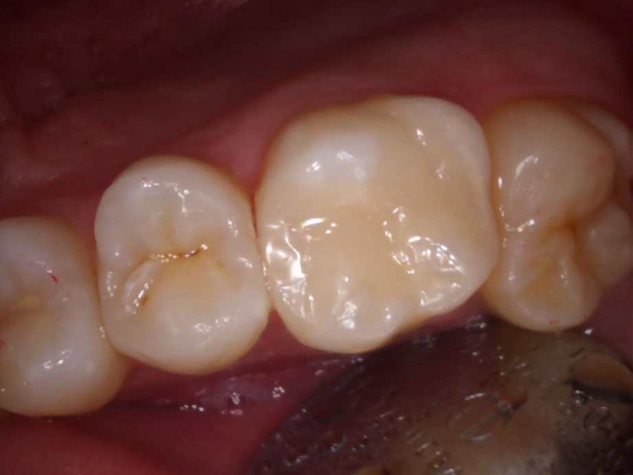 治療後（奥歯）