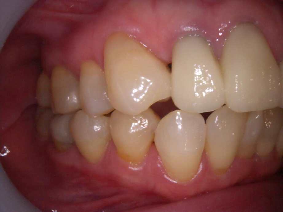 治療後（右側面）