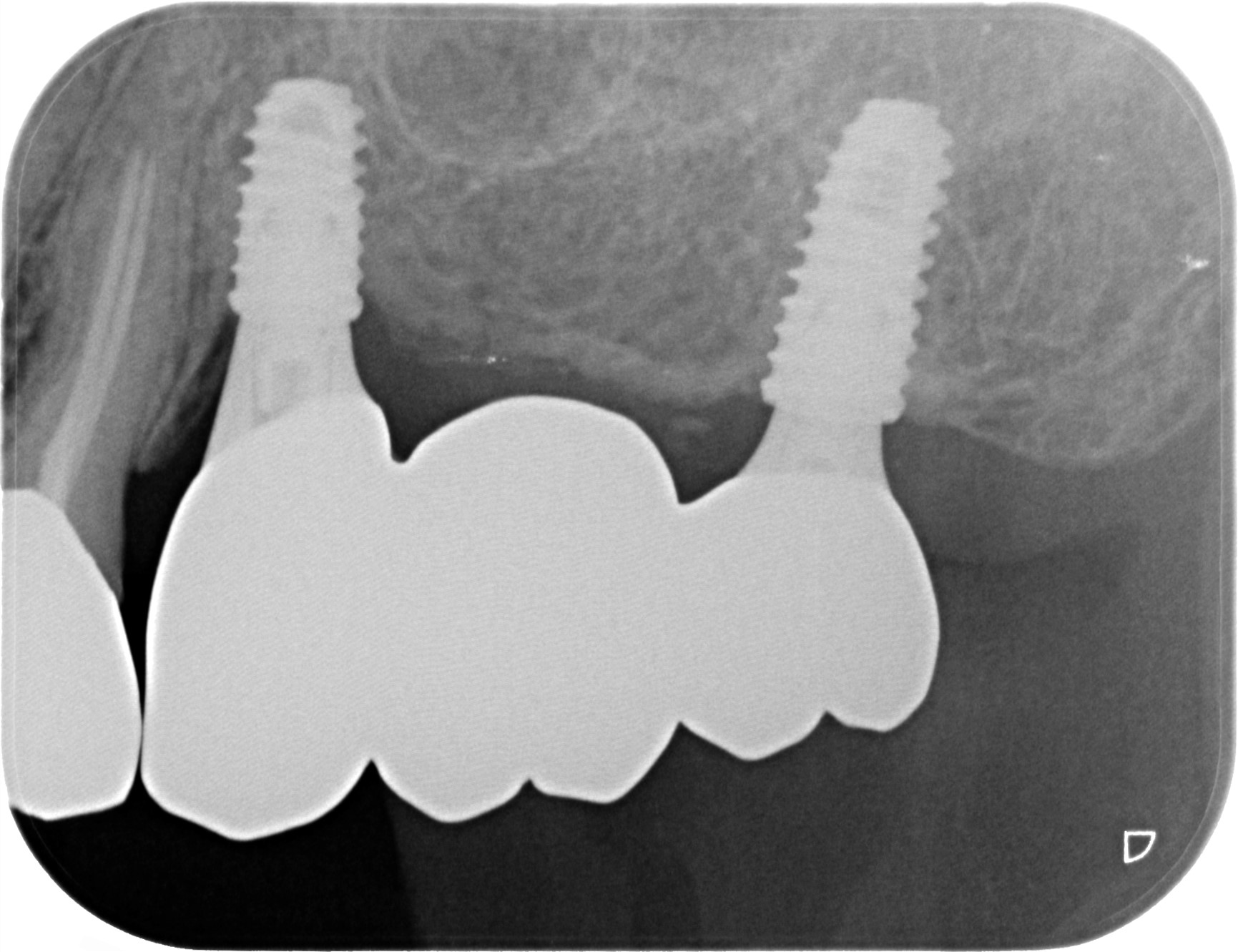 治療後レントゲン写真