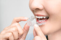 マウスピース矯正（成人）