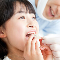マウスピース矯正（小児）