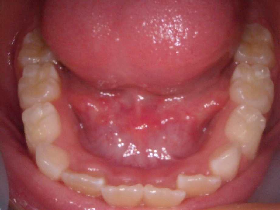 治療前（下顎）