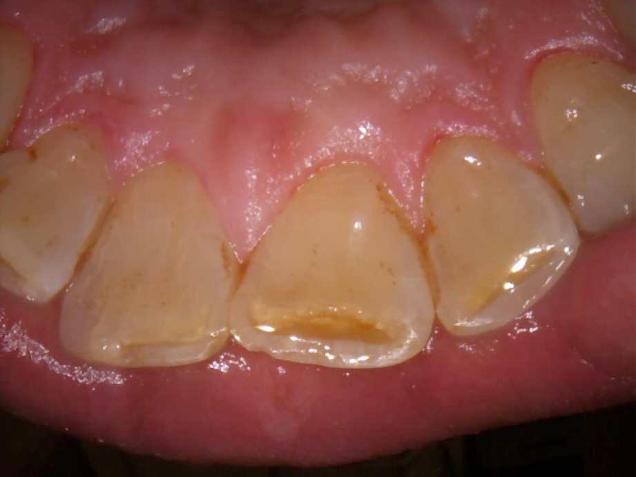 治療後（上顎）