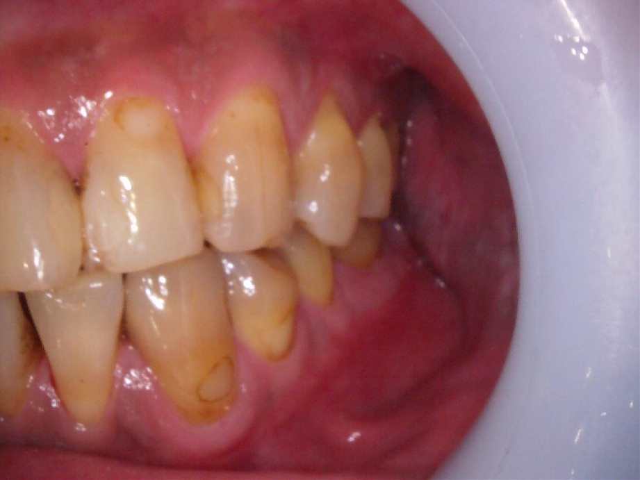 治療前（左側面）