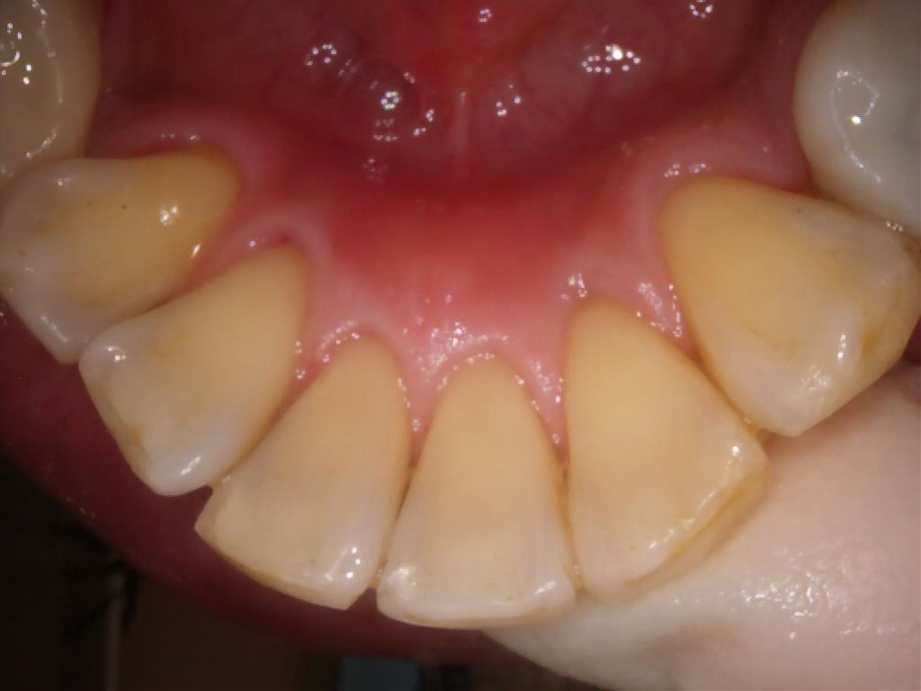 治療後（下顎）