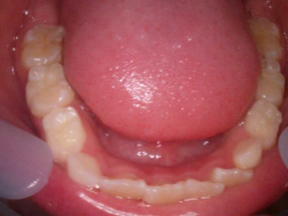 治療後（下顎）