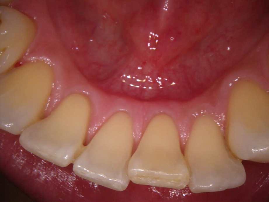 治療後（下顎）