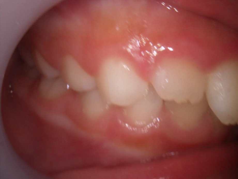 治療前（右側面）