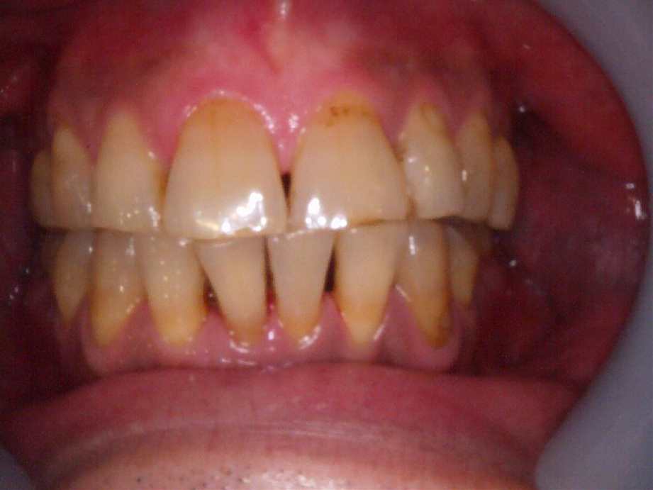 治療後（正面）