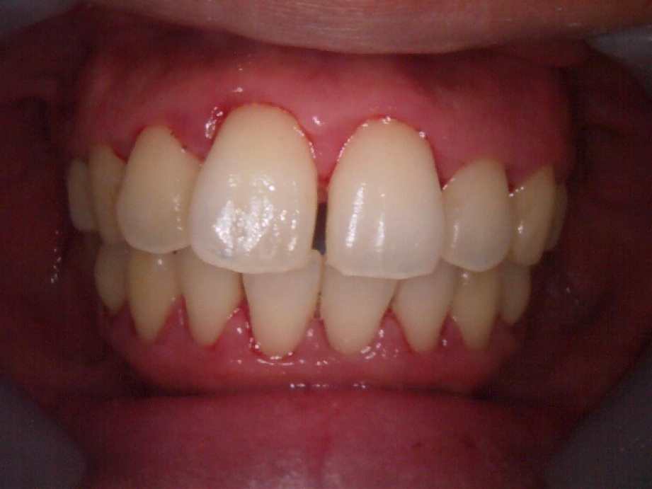 治療後（正面）