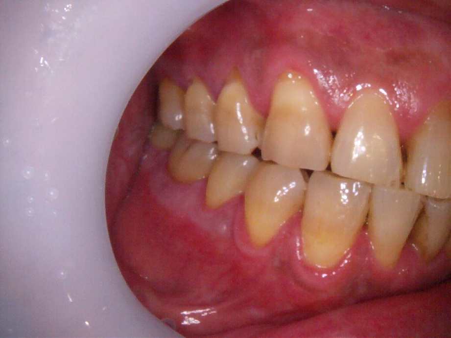 治療前（右側面）