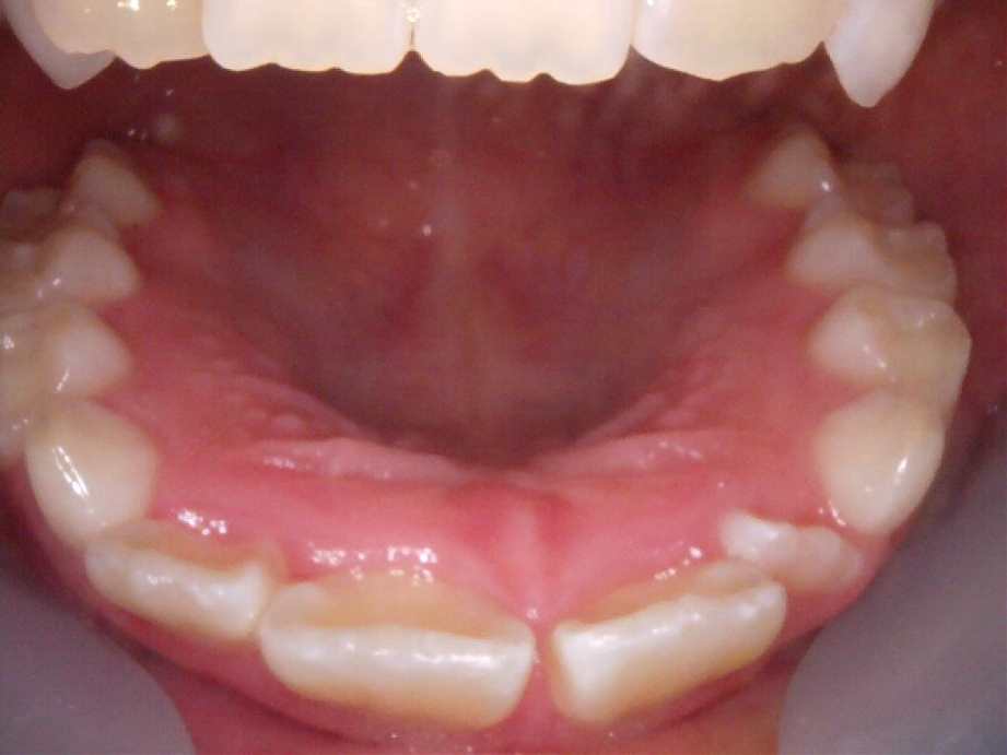 治療後（上顎）