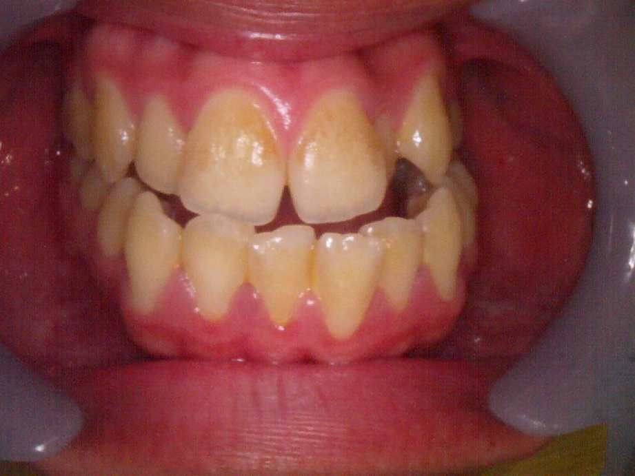 治療前（正面）