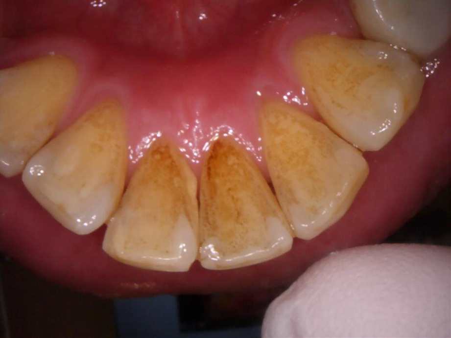 治療前（下顎）