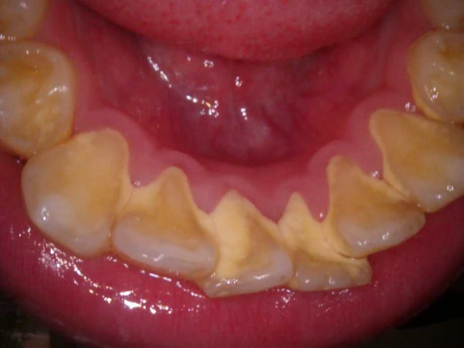 治療前（下顎）