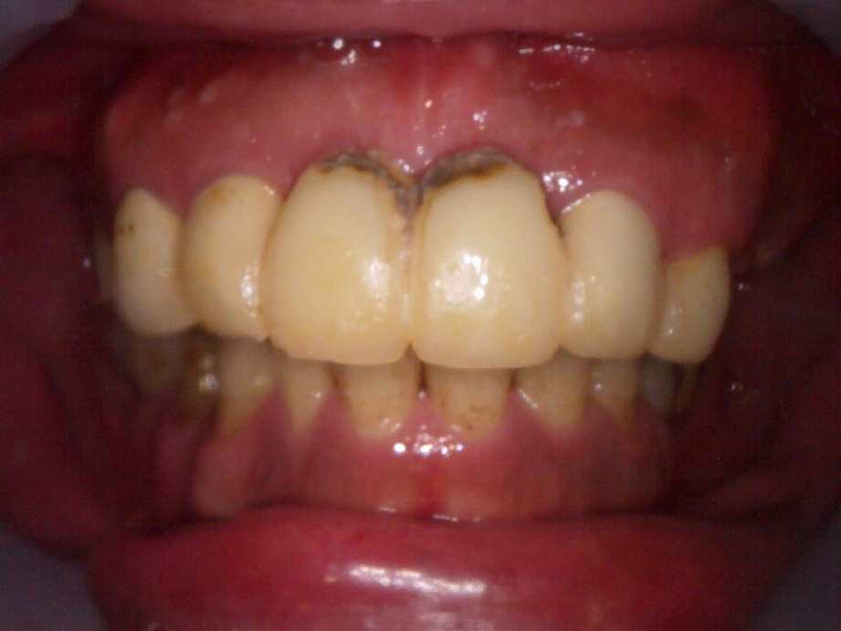 治療前（正面）