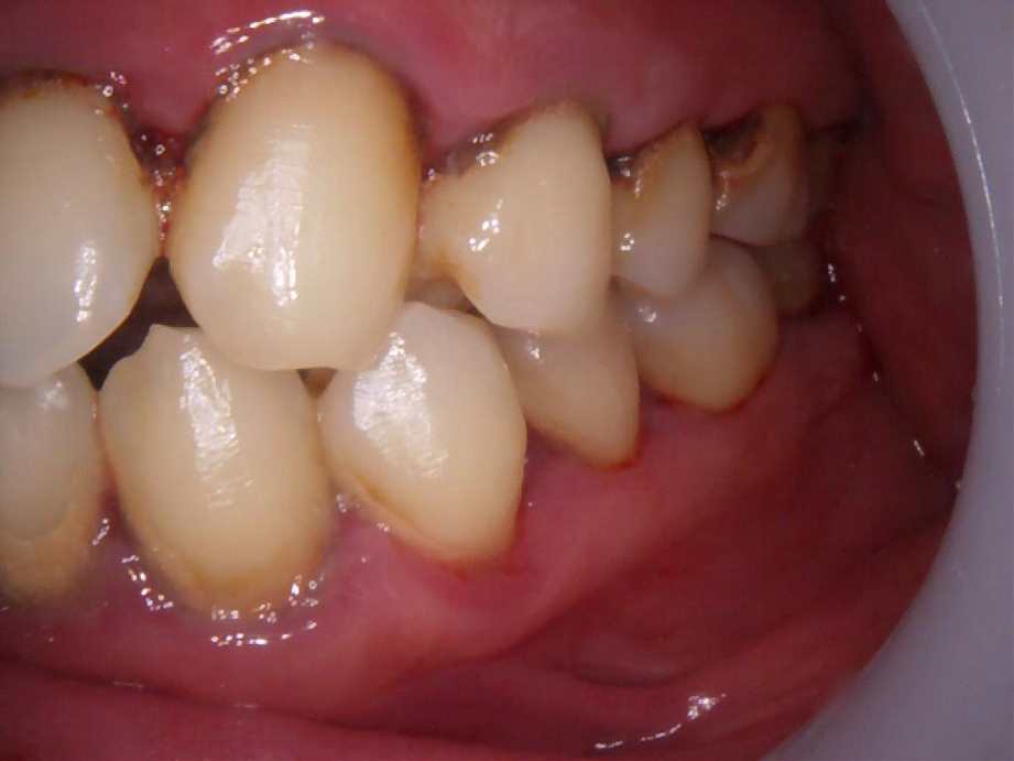 治療前（左側面）