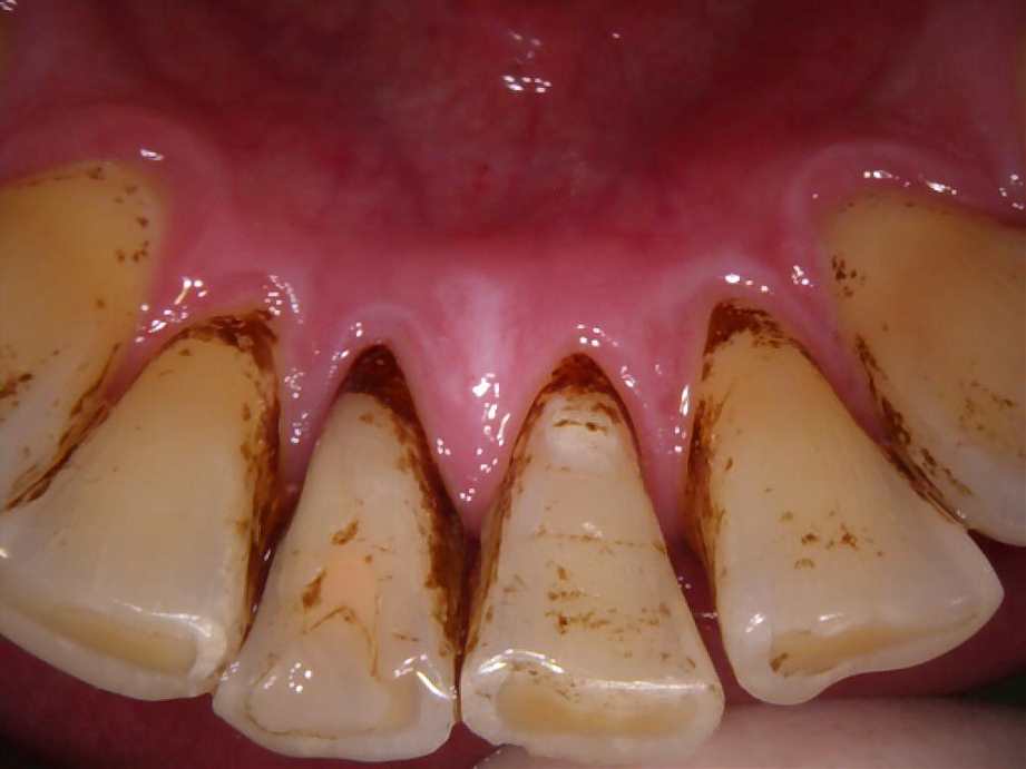 治療前（下顎）