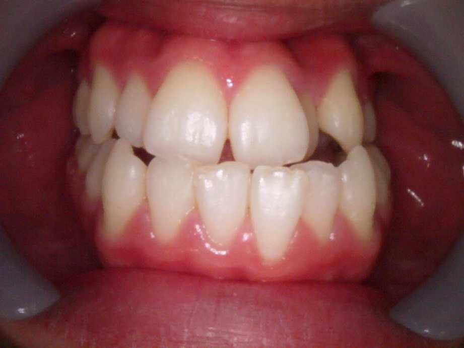 治療後（正面）