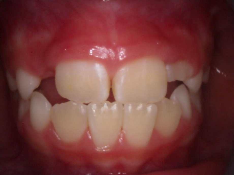 治療前（正面）